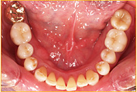 【症例】CASE1　奥歯1本の欠損をインプラントで治療治療後