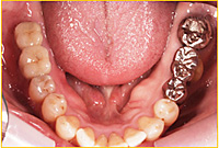 【症例】CASE2　奥歯2本の欠損をインプラントで治療治療後