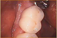 【症例】CASE3　奥歯への抜歯即時インプラント治療後