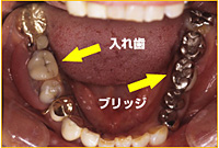 【症例】CASE4　入れ歯とブリッジからインプラント治療前