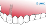 前歯のインプラント治療の特徴