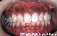 歯周病　初期の段階治療前
