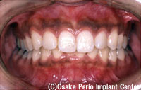 歯周病　初期の段階治療後