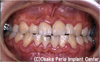 2.歯周病　中期の段階治療前