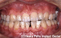 2.歯周病　中期の段階治療後