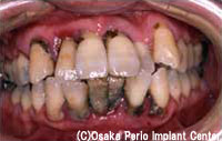 歯周病　重度の段階治療前