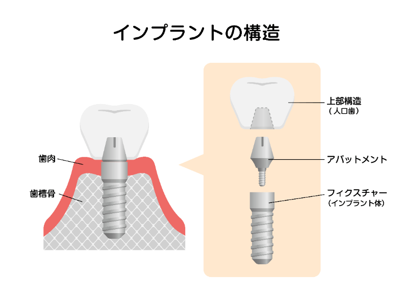 インプラント　メーカー