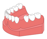 歯を1本失った場合の治療費用
