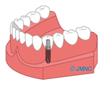 インプラント治療の場合