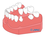ブリッジ治療の場合