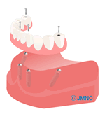 インプラントAll-on-4（オールオンフォー）治療の場合