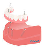 インプラントAll-on-4（オールオンフォー ）と総入れ歯の費用比較
