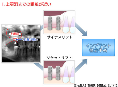  上顎洞までの距離が近い