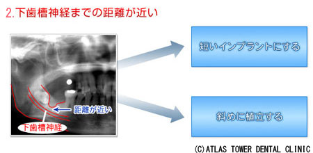  下歯槽神経までの距離が近い