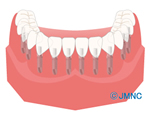■ 従来のインプラント治療