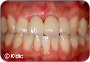 補綴治療（最終的な被せものを装着）治療後