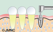 口腔外科で行われるインプラント治療
