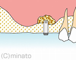 吸い取ります
