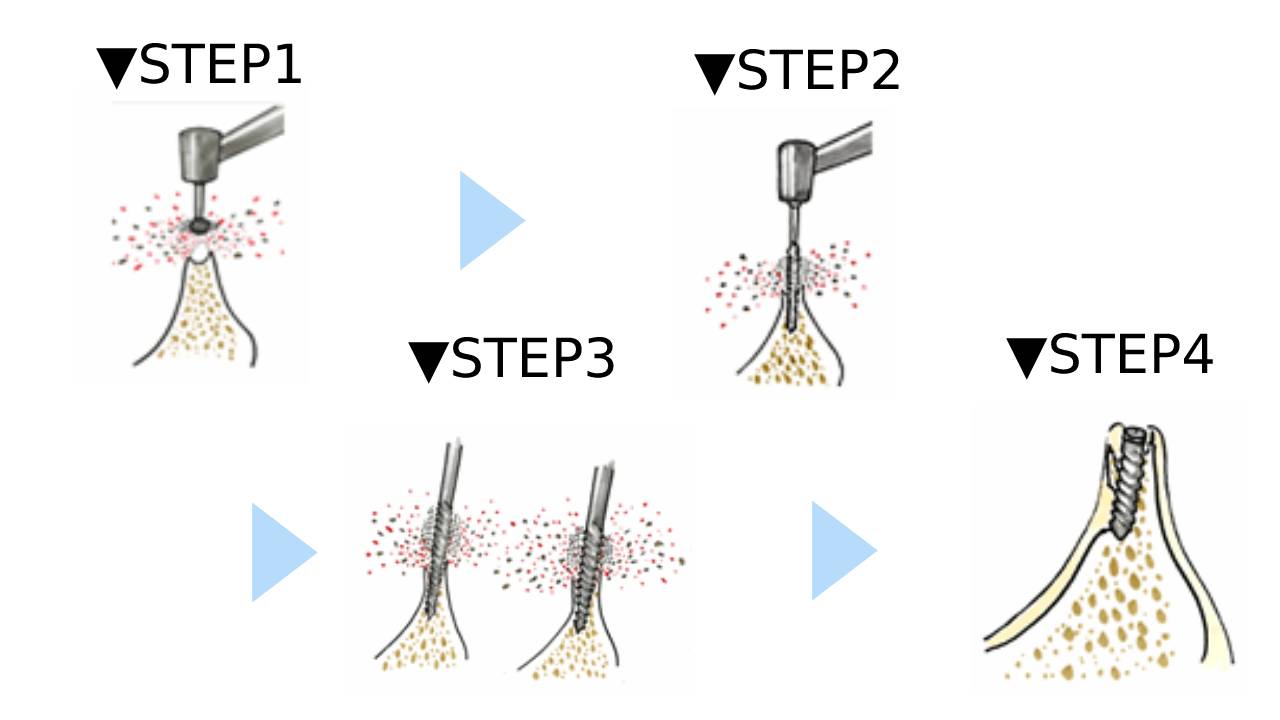 従来のインプラント手術