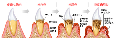 歯周病の進行状態