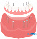 先進医療と認められてきた「インプラント義歯」が保険適用に