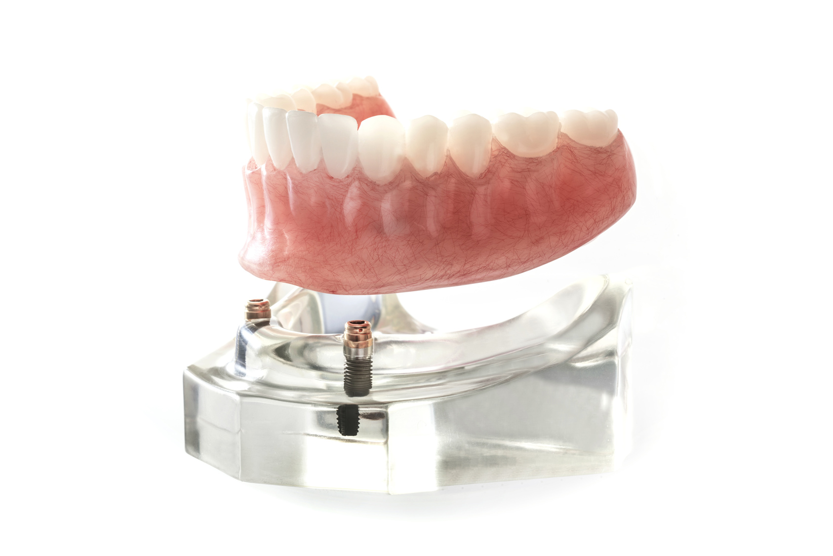 先進医療のインプラント義歯が保険適用になる？