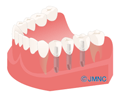  インプラントとメンテナンス