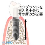 顎の骨が足りない場合に必要な「骨造成」