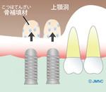 ソケットリフト