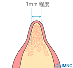 顎の骨の幅だけが痩せている場合