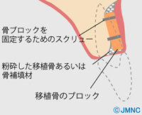 骨移植（ベニアグラフト、ブロック骨移植）