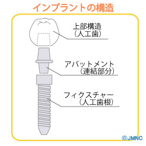 インプラントの構造