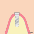  インプラントの埋入手術②