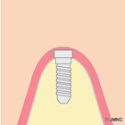 インプラントの埋入手術③