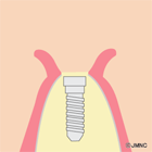 アバットメントの連結手術（2回目の外科手術）①
