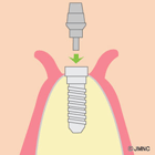 アバットメントの連結手術（2回目の外科手術）③