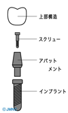 インプラントの構造