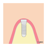 インプラント治療PATTERN1　二回法