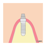 インプラント治療PATTERN2　一回法