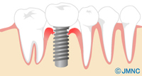 インプラント周囲炎の症状