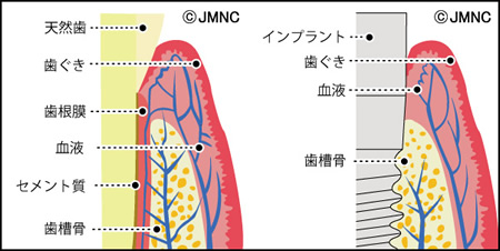 インプラントの周りの組織の特徴