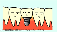 インプラントの利点