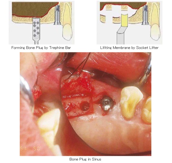 側方からのサイナスリフト適応症例に対して歯槽骨頂からのアプローチ