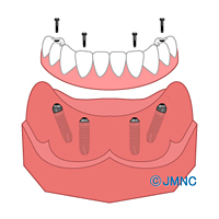 最少4本のインプラント治療All-on-4