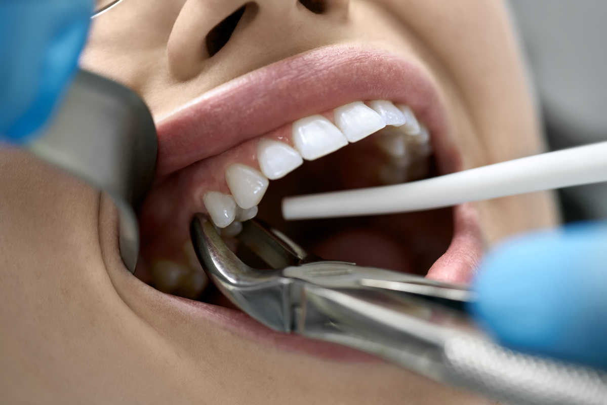 歯を抜いてすぐにインプラントを埋め込む「抜歯即時埋入」