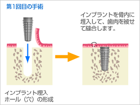 インプラント『2回法手術①』