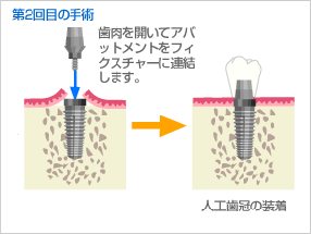 インプラント『2回法手術②』