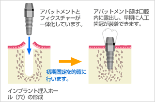 インプラント『1回法手術』