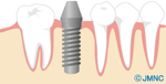 インプラント治療は外科手術を伴います