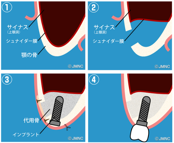 イナスリフトの治療方法